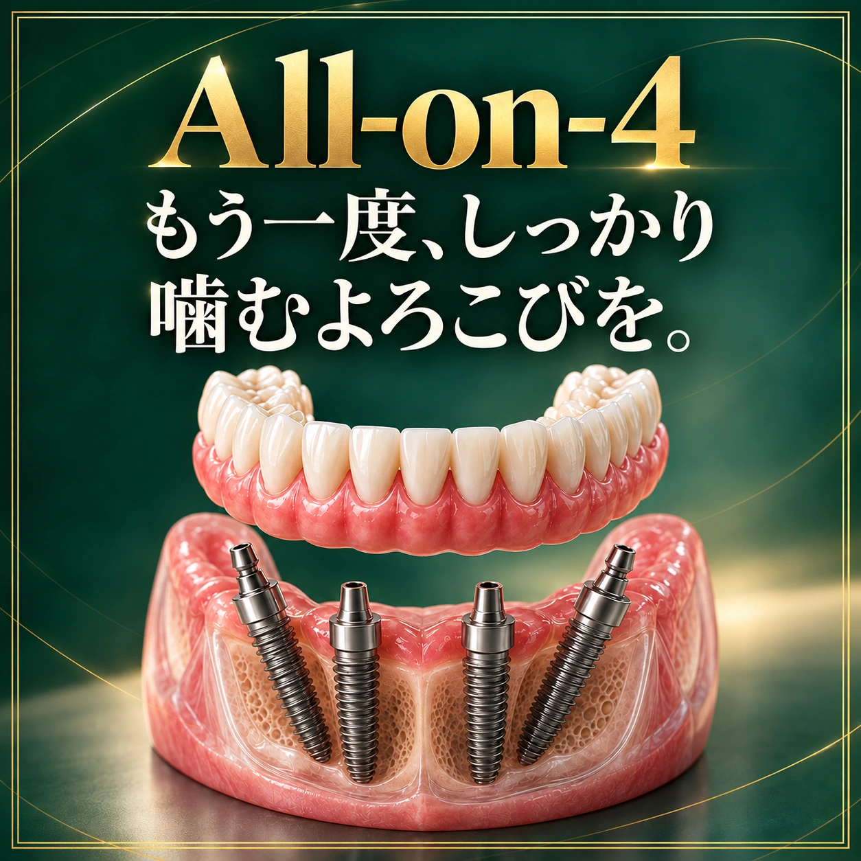 All-on-4。もう一度、しっかり噛むよろこびを。4本のインプラントで支える人工歯列の説明イメージ