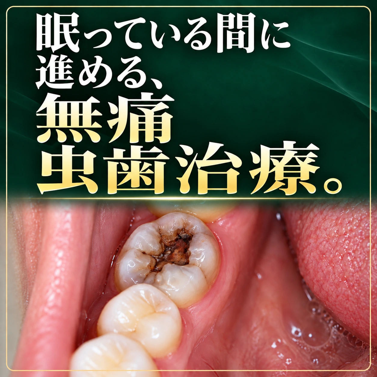 眠っている間に進める、無痛虫歯治療。