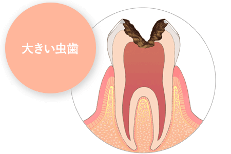 大きい虫歯