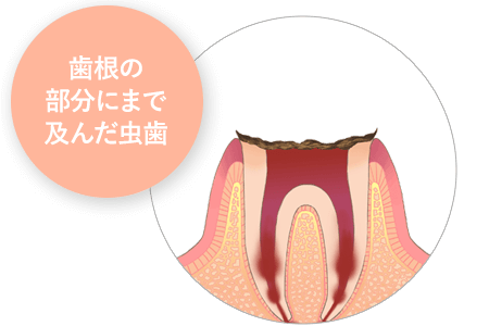 歯根の部分にまで及んだ虫歯
