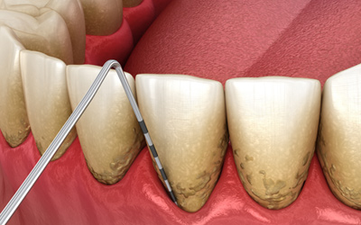 歯周病の再感染リスクがある保険診療での治療